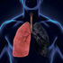 Lung cancer