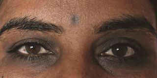 Inflammation from the eyes can cause redness and irritation leading to eye bags.