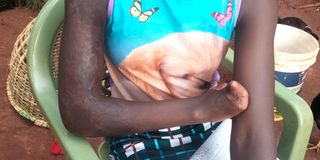 Roselyne Nakhumicha, 16, shows her amputated arm during an interview with Nation.Africa at her parents' home in Trans Nzoia