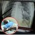 X-ray scan showing some of the bullets lodged in body of 19-year-old Fidel Castro Ochieng