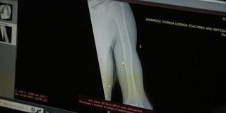 X-ray scan showing some of the bullets lodged in the arm of 19-year-old Fidel Castro Ochieng