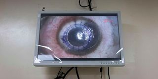 Cornea