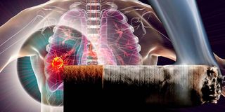 lung cancer