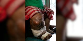 Elephantiasis