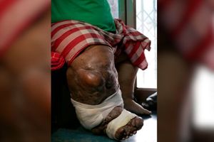 Elephantiasis