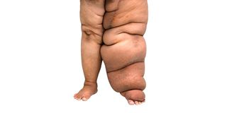 Elephantiasis