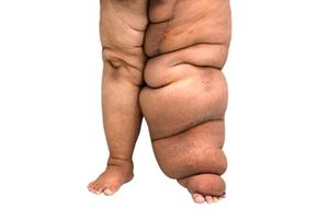 Elephantiasis